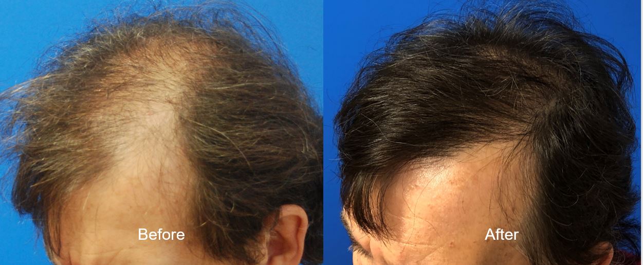 2000 FUT Graft Hair Transplant Comb Thru At 12 Months Post Op Hair