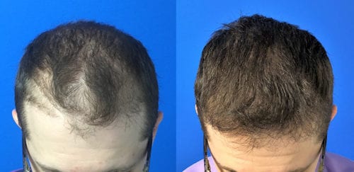 Case Study Archives - Page 2 of 4 - Hair Restoration Center of CT | FUE  Hair Transplant