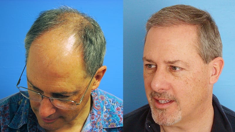 Patient Video Hair Restoration Testimonial - Hair Restoration Center of CT  | FUE Hair Transplant