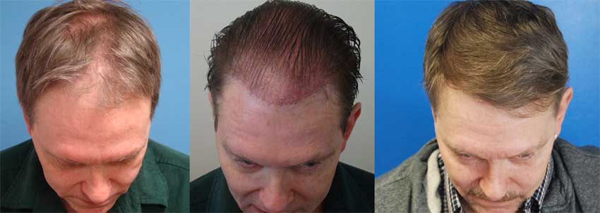 Left to Right - Before, Immediately After Surgery and 8 Months After Surgery