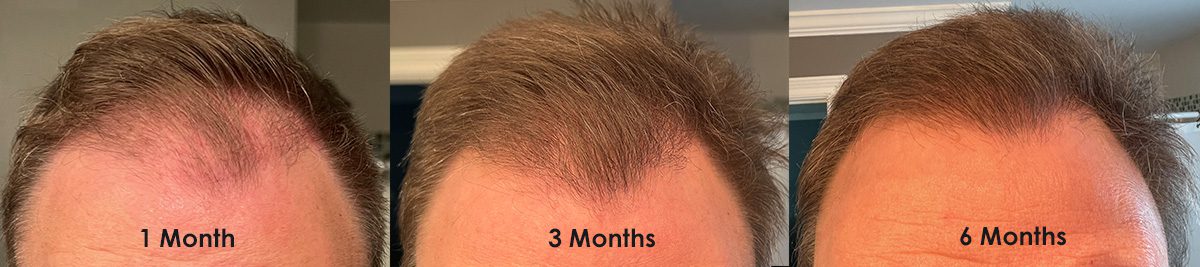 This 28 Year Old Male Came To Carolinahairsurgery Facebook 43 OFF