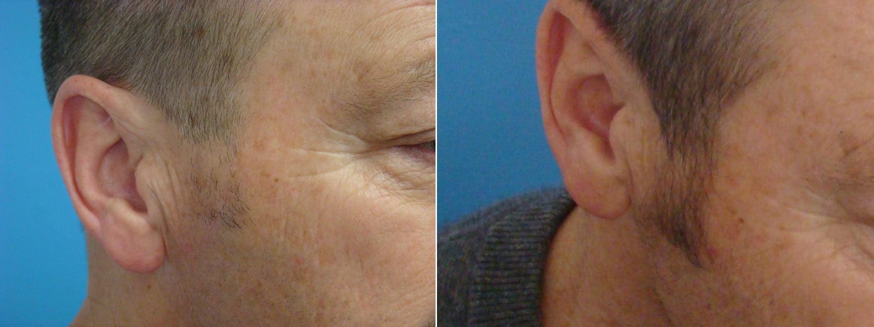 Before and After Sideburns Boden Hair Restoration Center of CT FUE
