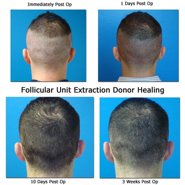 Post Op Recovery Photographs – 2 Weeks After FUE Hair Transplant Procedure