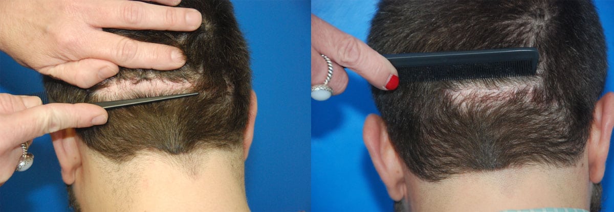 Donor Scar Repair With FUE Hair Transplant - Hair Restoration Center of CT  | FUE Hair Transplant