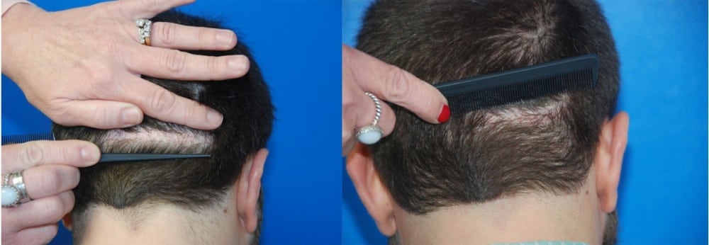 Donor Scar Repair With FUE Hair Transplant - Hair Restoration Center of CT  | FUE Hair Transplant
