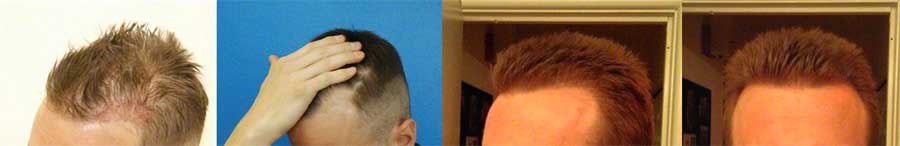 FUE 800 grafts. I Am So Glad I Made This Decision! - Hair Restoration  Center of CT | FUE Hair Transplant