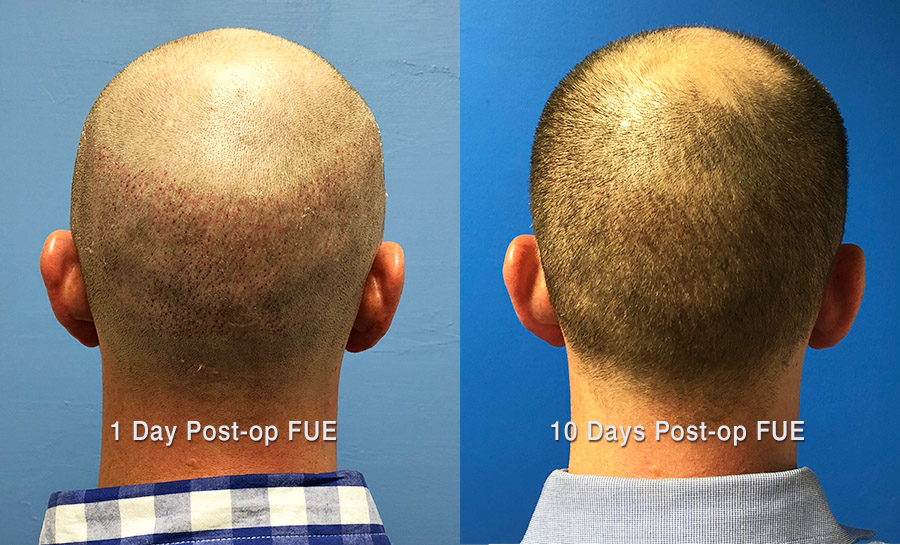 8 Month Video FUE Case Study Follow Up - Hair Restoration Center of CT | FUE  Hair Transplant
