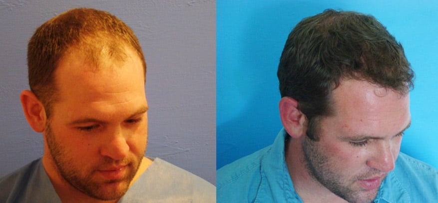 FUE Hair Transplant - Before (L) & After (R)