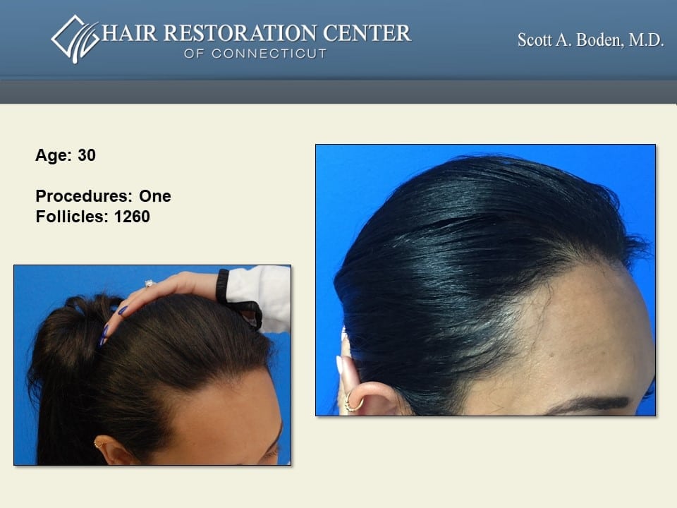 Female Hair Transplant Before & After Photos | Hair Transplant CT | Scott  Boden, MD