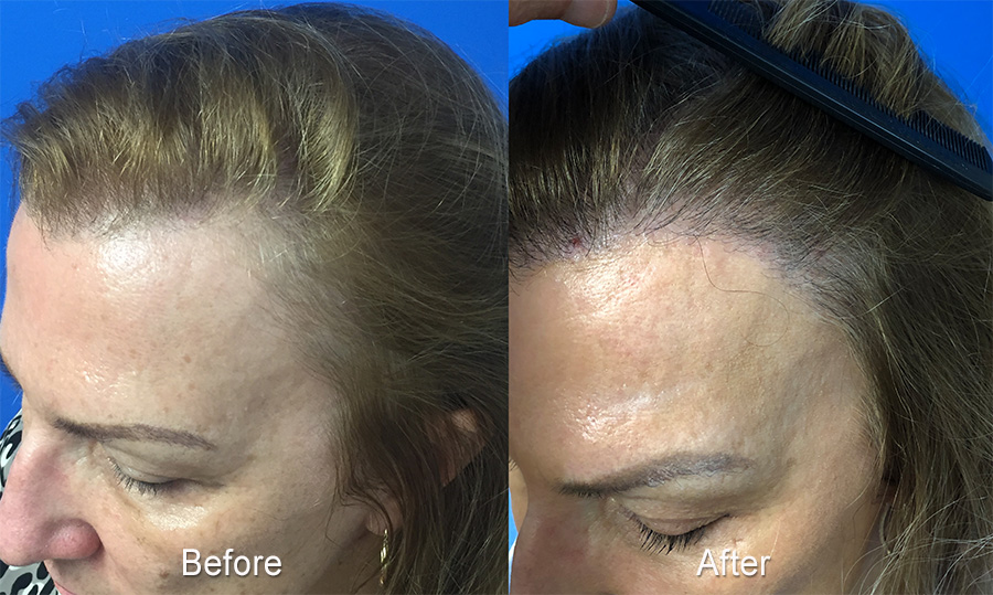 Female Hairline Restoration Case Study - Hair Restoration Center of CT | FUE  Hair Transplant