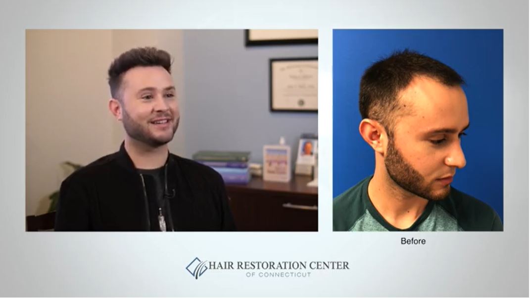Hair Restoration Center of Connecticut and Western Massachusetts | Hair  Transplant CT | FUE Hair Transplant