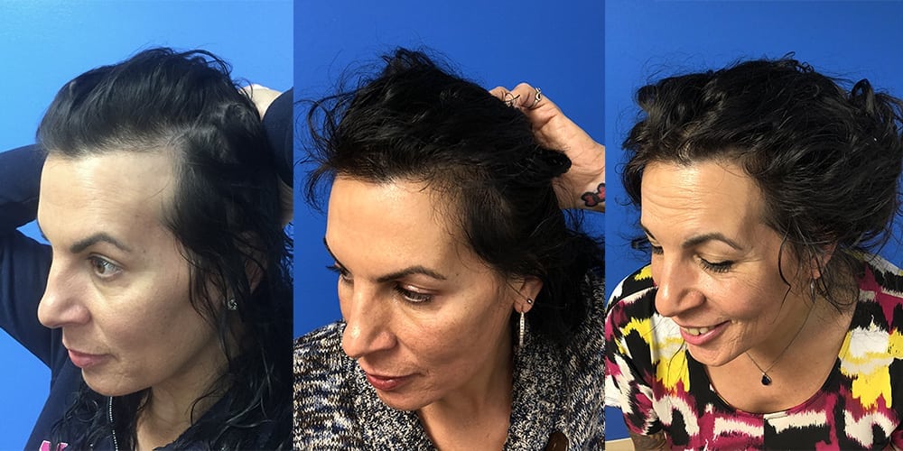 Transgender Hair Transplant | Hair Restoration | Hartford, Connecticut (CT)