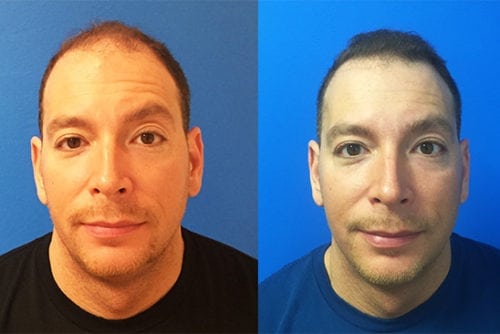 Before and After FUE Hair Transplant