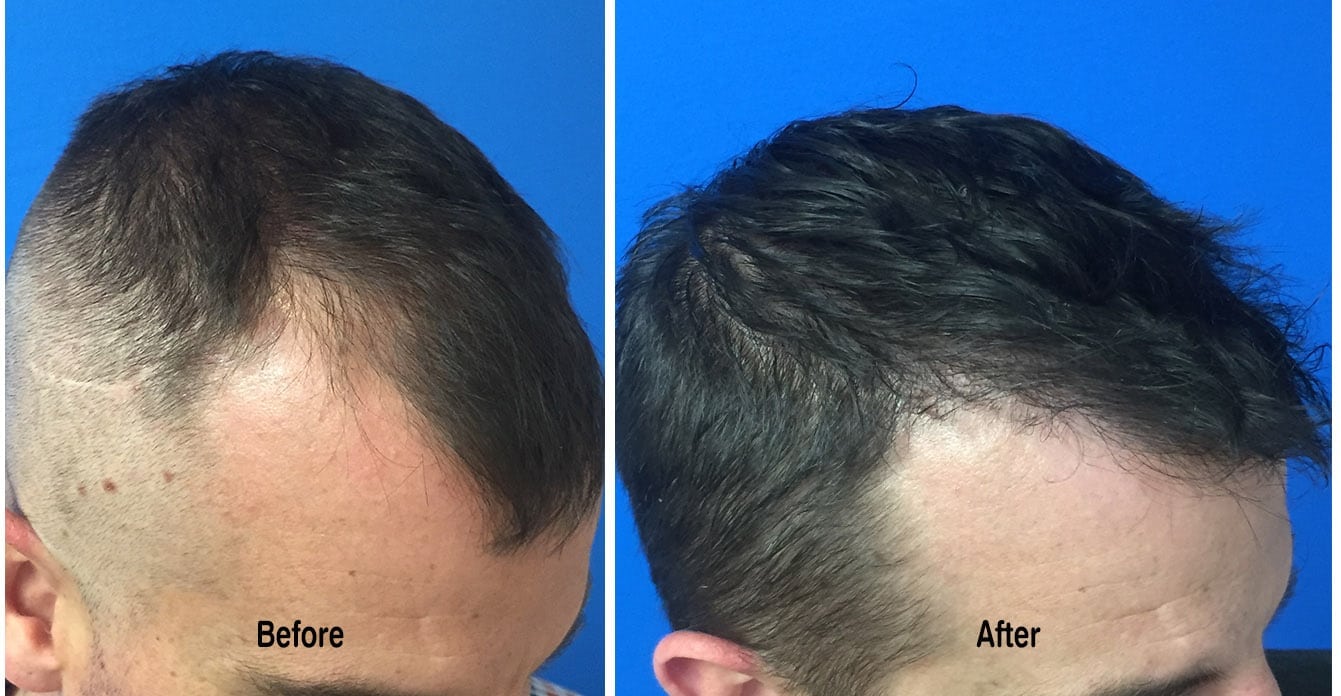 Before and After Hair Transplant Surgery with Dr. Scott Boden