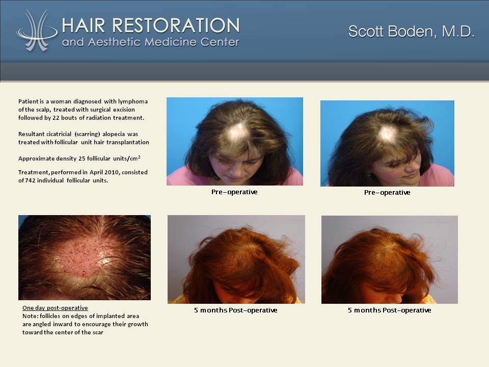 Female Hair Transplant | Hair Restoration For Women in CT