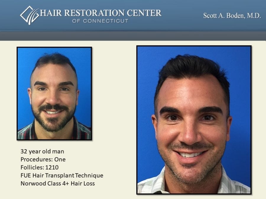 Kidney transplant case study picture