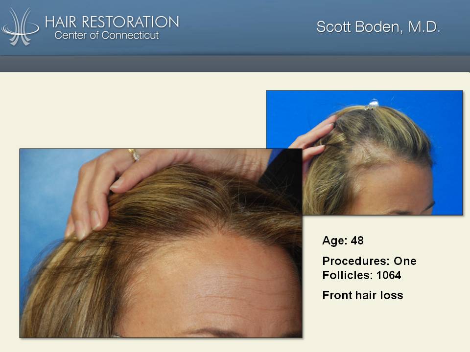 Female Hair Transplant Before & After Photos | Hair Transplant CT | Scott  Boden, MD
