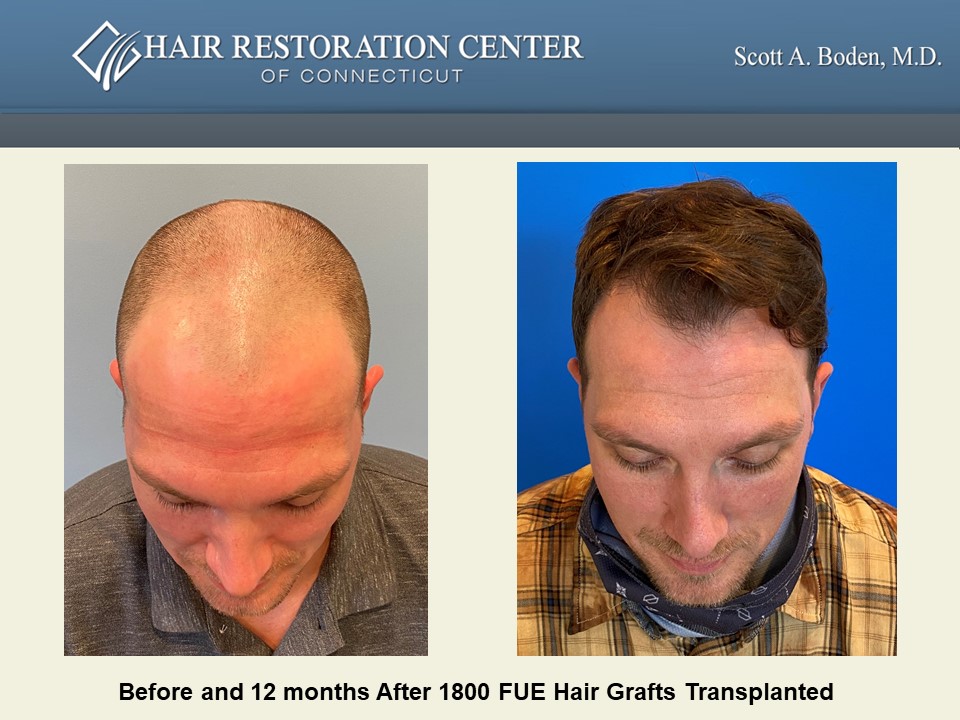 Slide113 - Hair Restoration Center of CT | FUE Hair Transplant