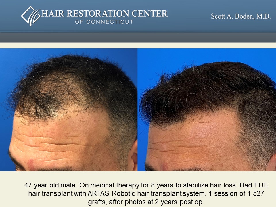 FUE - ARTAS Robotic Hair Transplant Case Study - Hair Restoration Center of  CT | FUE Hair Transplant