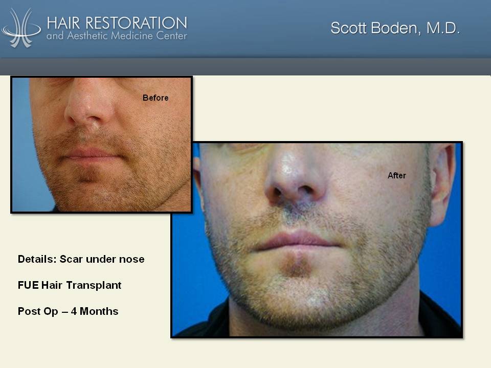 FUE hair transplant from beard covers facial scar in mustache area - Hair  Restoration Center of CT | FUE Hair Transplant