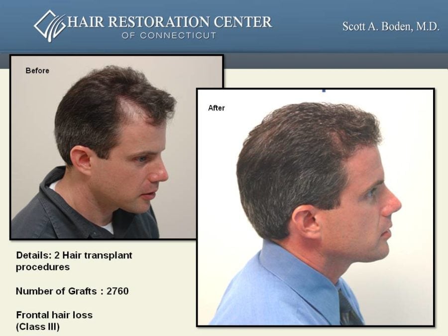 Slide17 Hair Restoration Center of CT FUE Hair Transplant