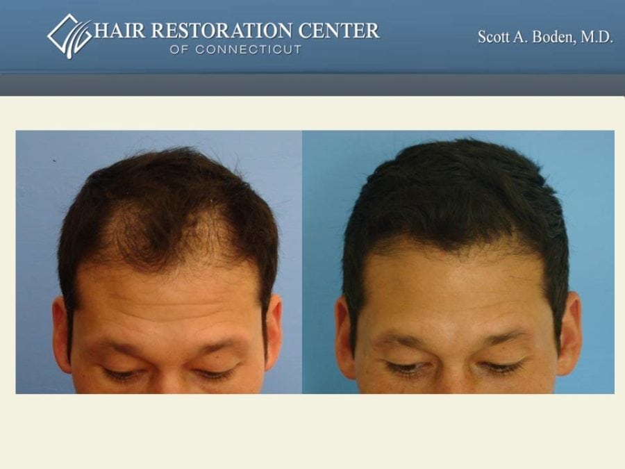 Slide7 Hair Restoration Center of CT FUE Hair Transplant