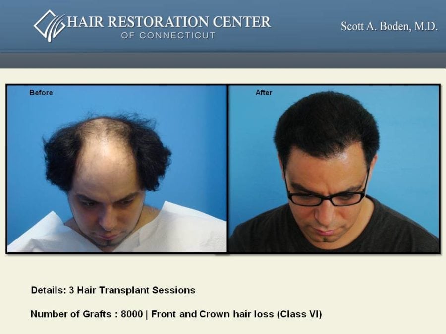 Slide93 Hair Restoration Center of CT FUE Hair Transplant